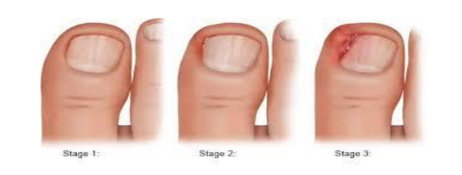 Ingrown toenail? Is nail surgery the answer? Some of your questions  answered - Foot + Nail Solutions